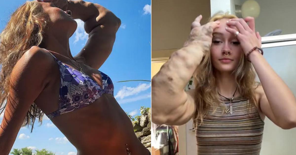 Cô gái sinh ra với cánh tay khổng lồ vì một tình trạng hiếm gặp